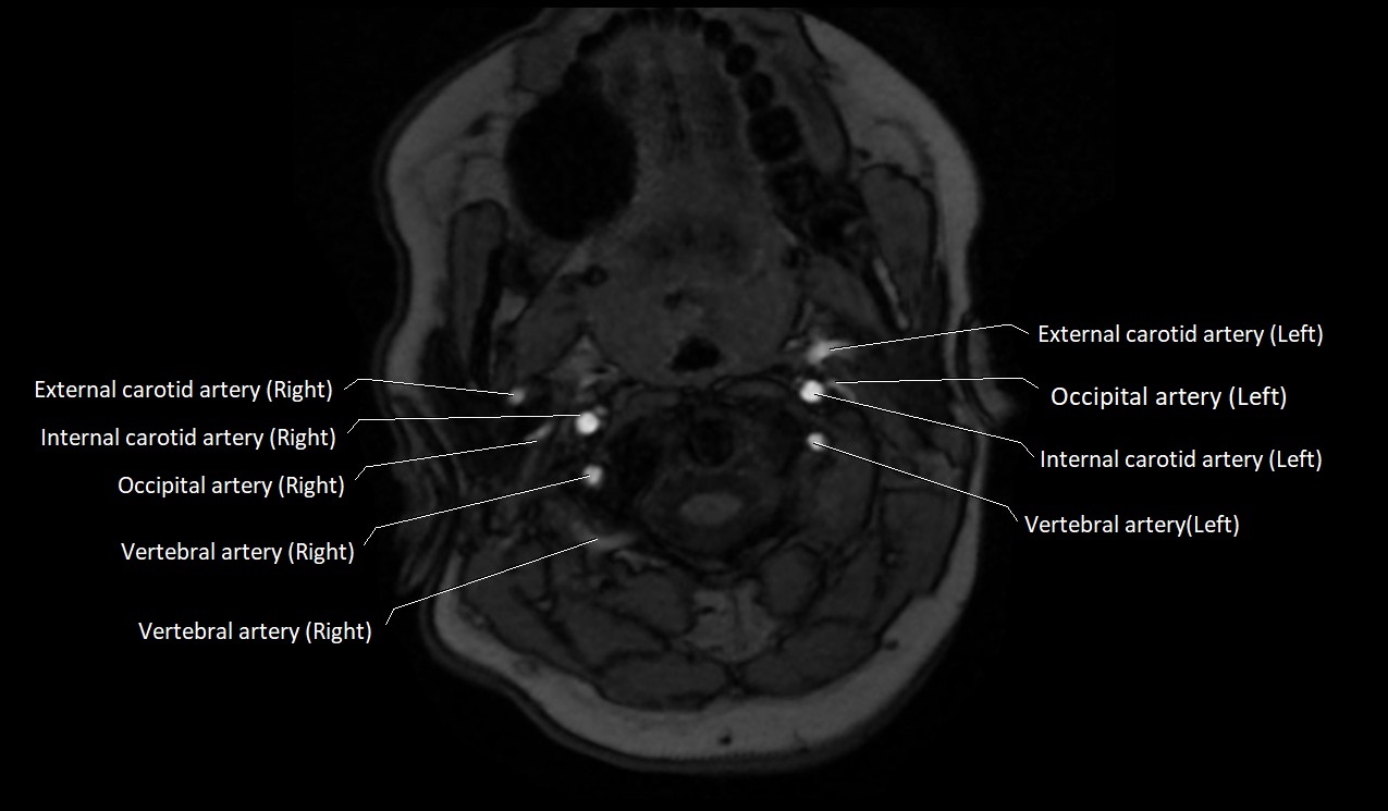 Carotid artery anatomy axial 3T image 14.jpg